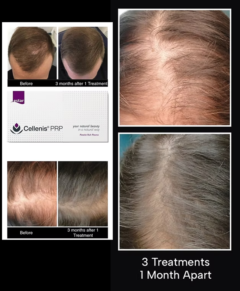 prp hair loss treatment from dr ricky stratford.